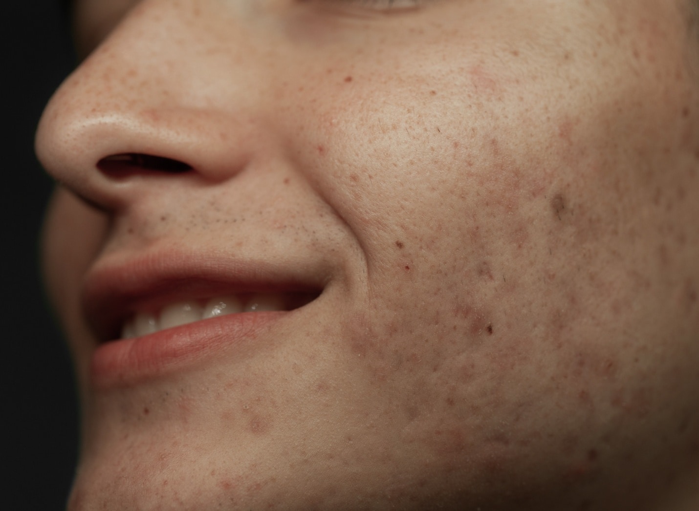 Vue rapprochee sur le visage d un homme souriant avec des traces de boutons j ai des cicatrices | Maison abeille esthetique Paris